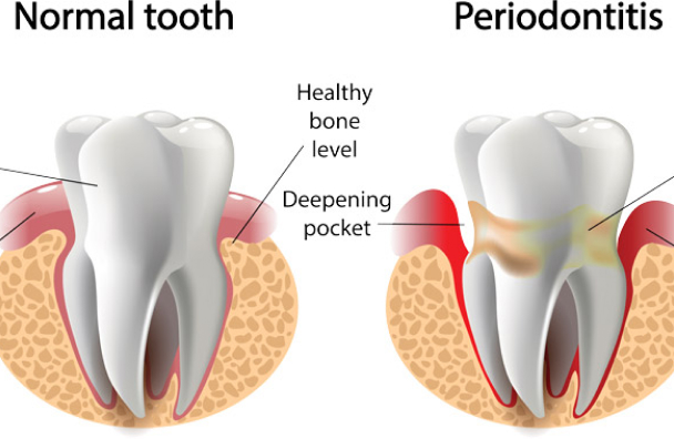 Periodontal Therapy 
